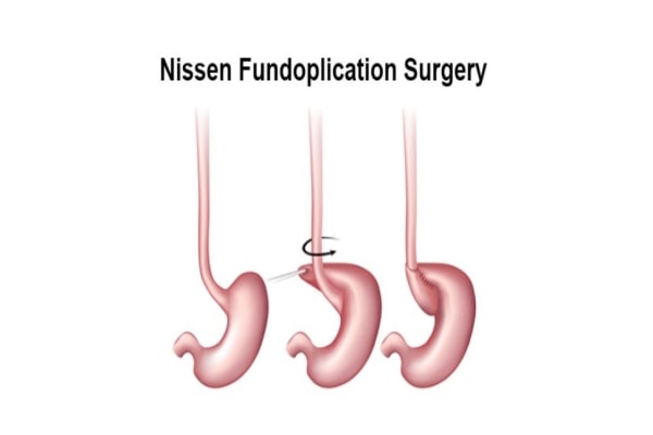 Best Fundoplication Doctors in Whitefield, Bangalore